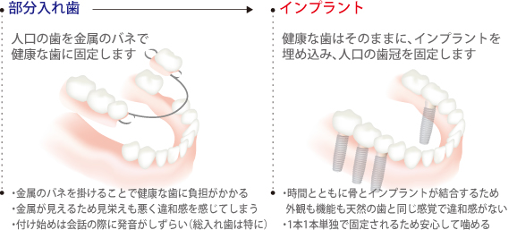 部分入れ歯との比較図