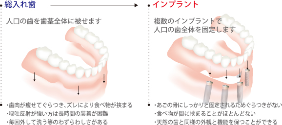 総入れ歯との比較図